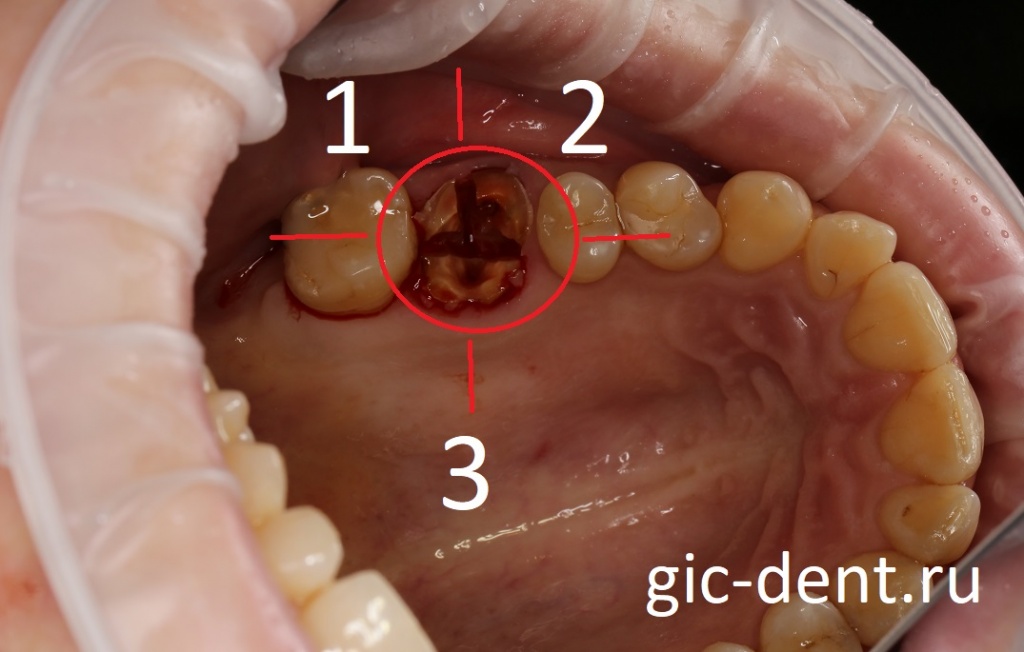 Так как это - шестой зуб, то он был разделен (фрагментирован) по корням на три сегмента